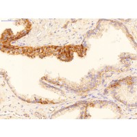 Antibody used in IHC on Human Prostate Cancer at 2 ug/ml.
