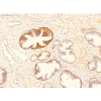 Antibody used in IHC on Human Prostate Cancer at 2 ug/ml.