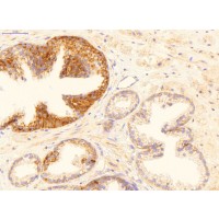 Antibody used in IHC on Human Prostate Cancer at 2 ug/ml.