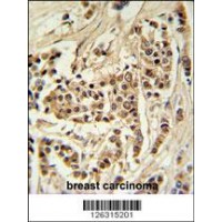 TTPAL Antibody IHC analysis in formalin fixed and paraffin embedded human breast carcinoma followed by peroxidase conjugation of the secondary antibody and DAB staining.