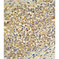 UDB17 Antibody IHC analysis in formalin fixed and paraffin embedded human Prostate carcinoma followed by peroxidase conjugation of the secondary antibody and DAB staining.