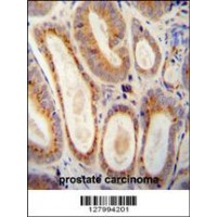 WFDC12 antibody immunohistochemistry analysis in formalin fixed and paraffin embedded human prostate carcinoma followed by peroxidase conjugation of the secondary antibody and DAB staining.