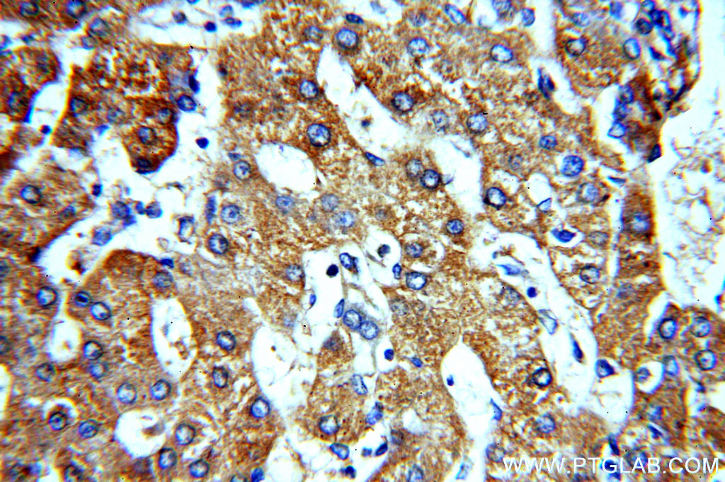 Immunohistochemical of paraffin-embedded human hepatocirrhosis using 20101-1-AP(ACTR10 antibody) at dilution of 1:100 (under 40x lens)