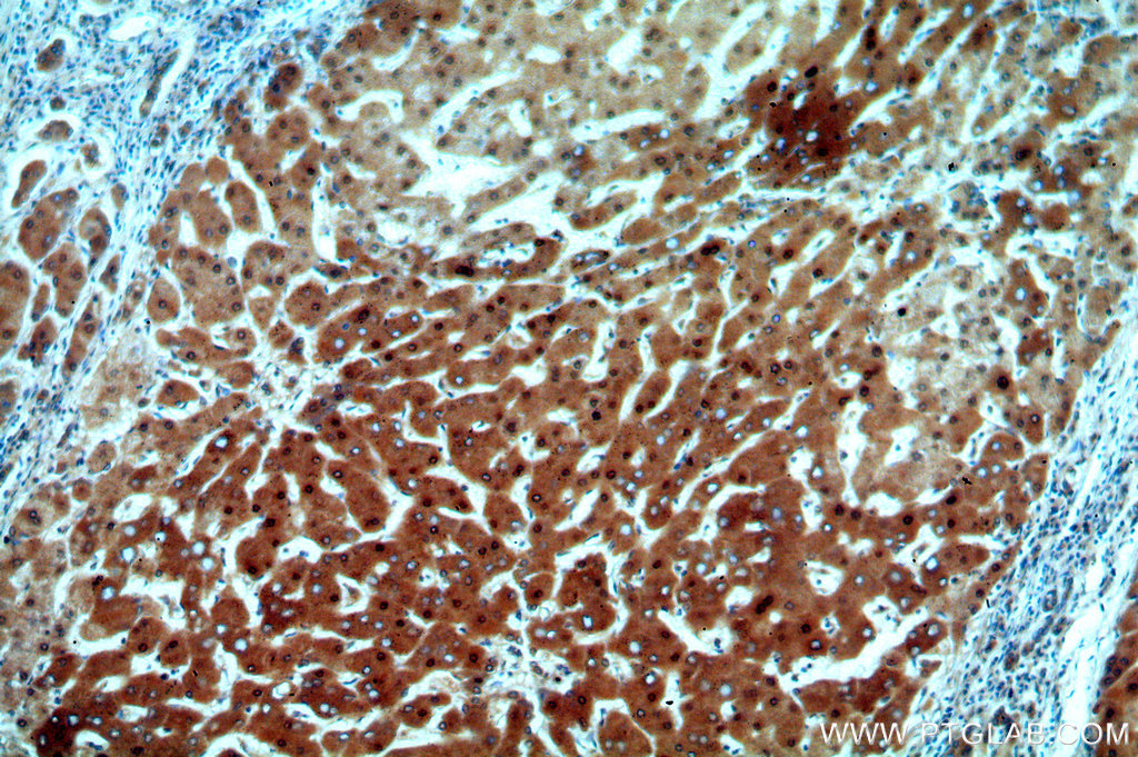 Immunohistochemical of paraffin-embedded human hepatocirrhosis using 13621-1-AP(ADAT2 antibody) at dilution of 1:50 (under 10x lens)