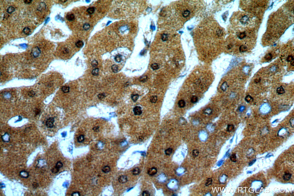 Immunohistochemical of paraffin-embedded human hepatocirrhosis using 13621-1-AP(ADAT2 antibody) at dilution of 1:50 (under 40x lens)