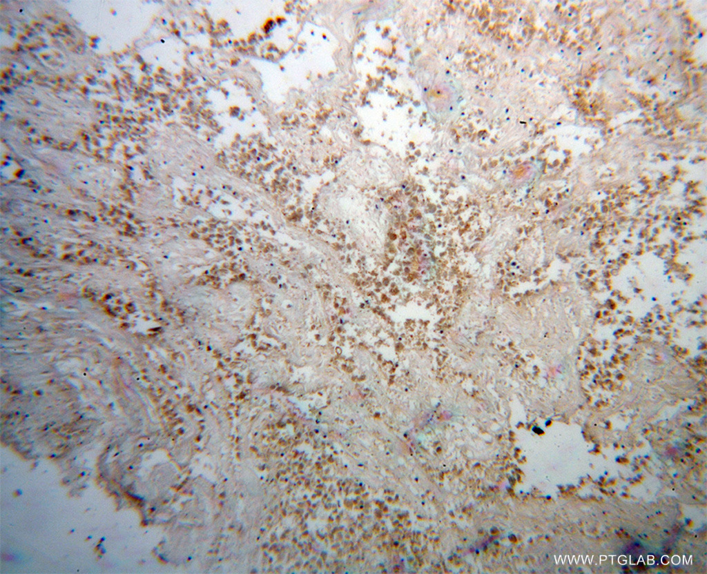 Immunohistochemical of paraffin-embedded human lung cancer using 13461-2-AP(BPIL1 antibody) at dilution of 1:100 (under 10x lens)