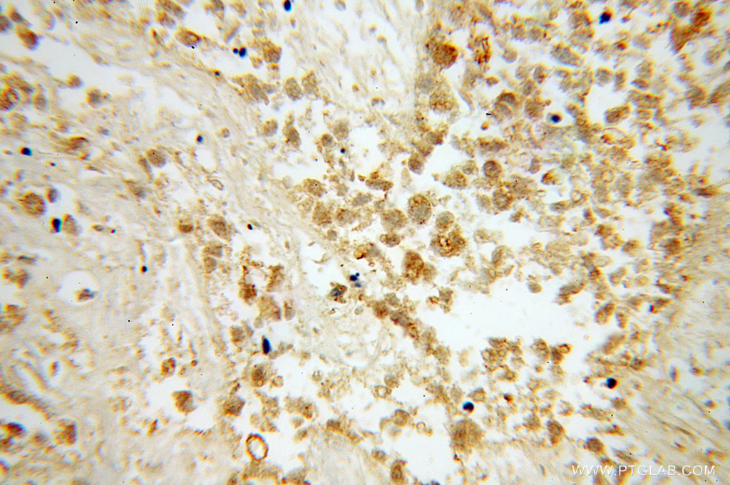 Immunohistochemical of paraffin-embedded human lung cancer using 13461-2-AP(BPIL1 antibody) at dilution of 1:100 (under 40x lens)