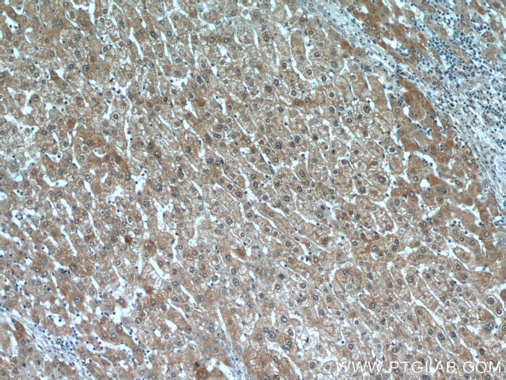 Immunohistochemical of paraffin-embedded human liver cancer using 20602-1-AP(C16orf70 antibody) at dilution of 1:100 (under 10x lens)