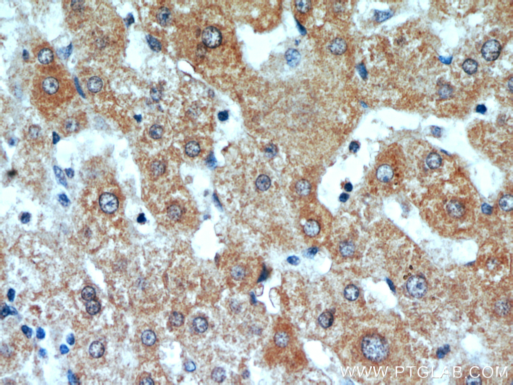 Immunohistochemical of paraffin-embedded human liver cancer using 20602-1-AP(C16orf70 antibody) at dilution of 1:100 (under 40x lens)