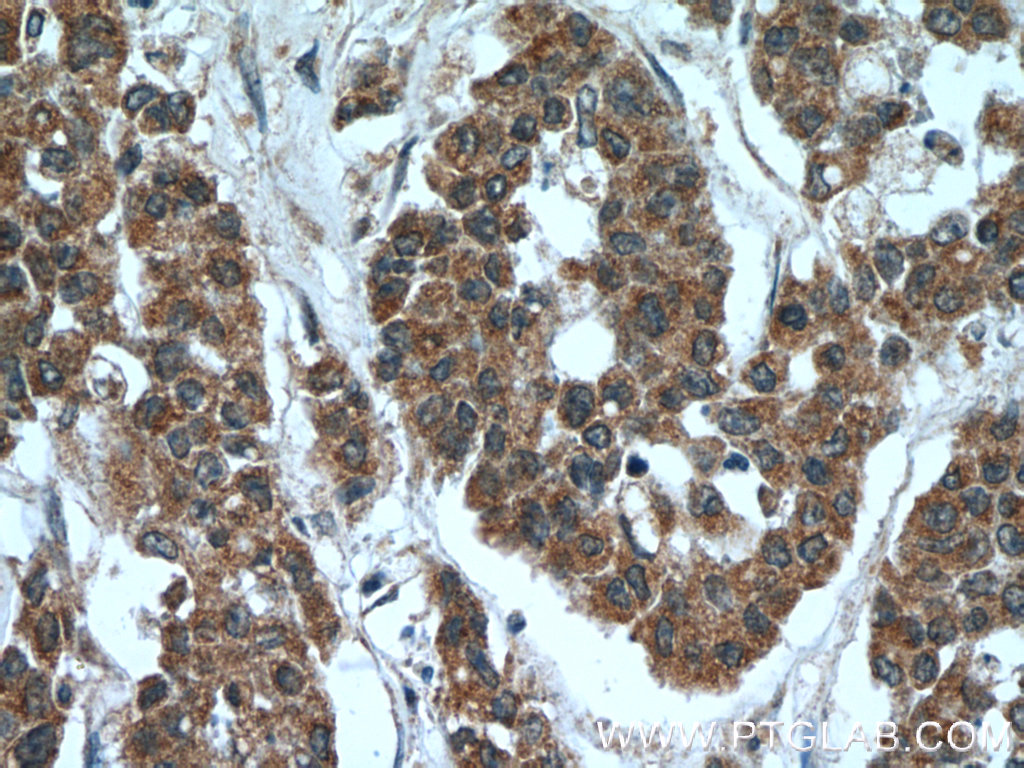 Immunohistochemistry of paraffin-embedded human colon cancer tissue slide using 22046-1-AP( C5orf4 Antibody) at dilution of 1:50 (under 40x lens)