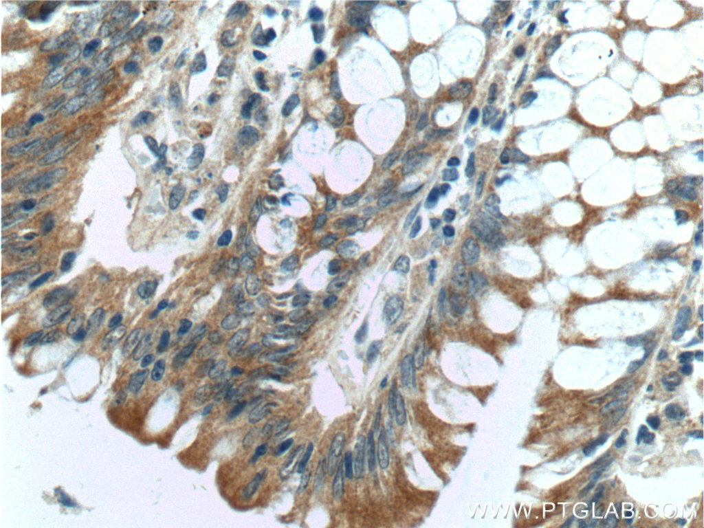 Immunohistochemistry of paraffin-embedded human colon tissue slide using 15040-1-AP( MRPL14 Antibody) at dilution of 1:50 (under 40x lens)