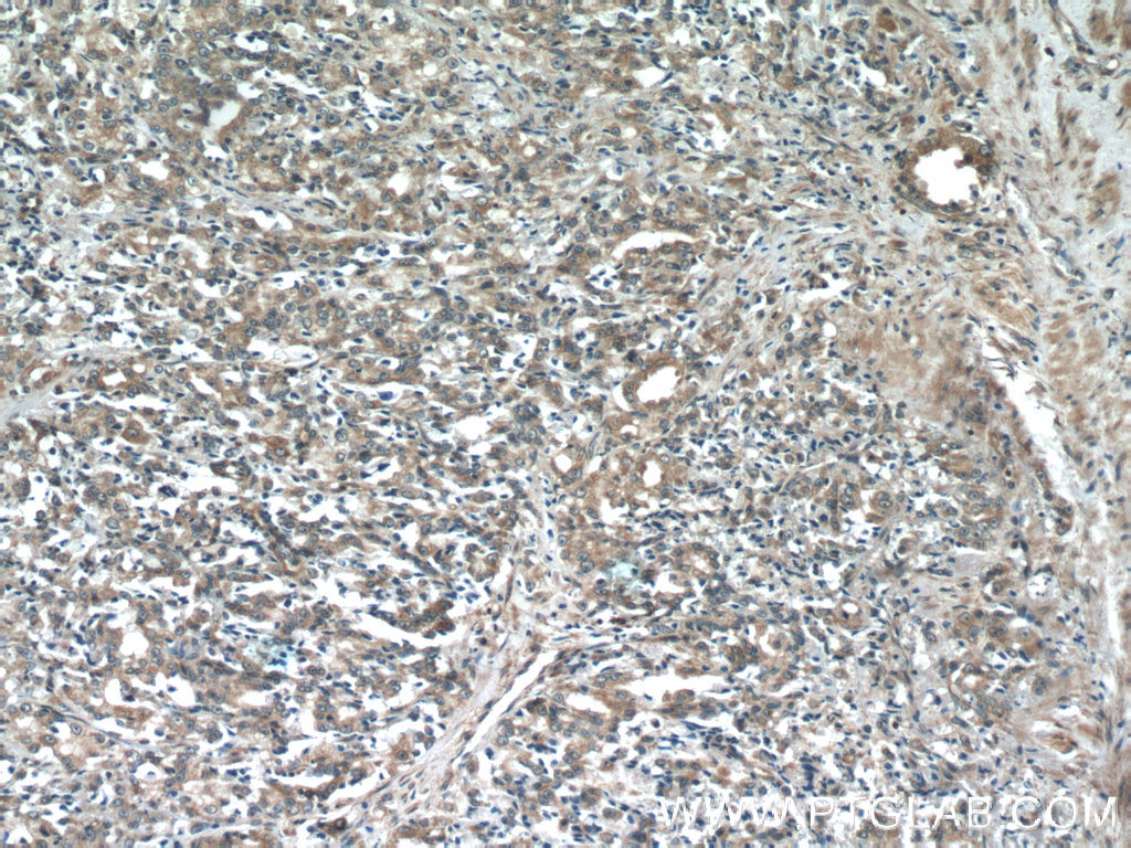 Immunohistochemistry of paraffin-embedded human prostate cancer tissue slide using 25752-1-AP( FAM36A Antibody) at dilution of 1:50 (under 10x lens)