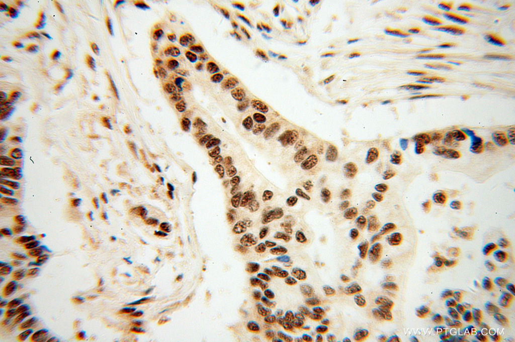 Immunohistochemical of paraffin-embedded human pancreas cancer using 14504-1-AP(CROP antibody) at dilution of 1:50 (under 40x lens)