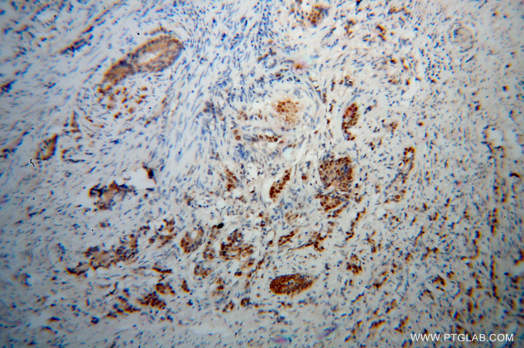 Immunohistochemical of paraffin-embedded human gliomas using 51050-1-AP(PNRC2 antibody) at dilution of 1:50 (under 10x lens)