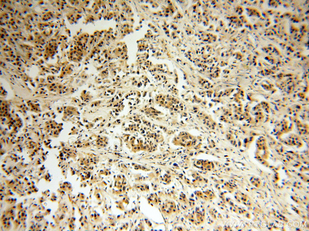 Immunohistochemical of paraffin-embedded human breast cancer using 18002-1-AP(P11 antibody) at dilution of 1:100 (under 10x lens)