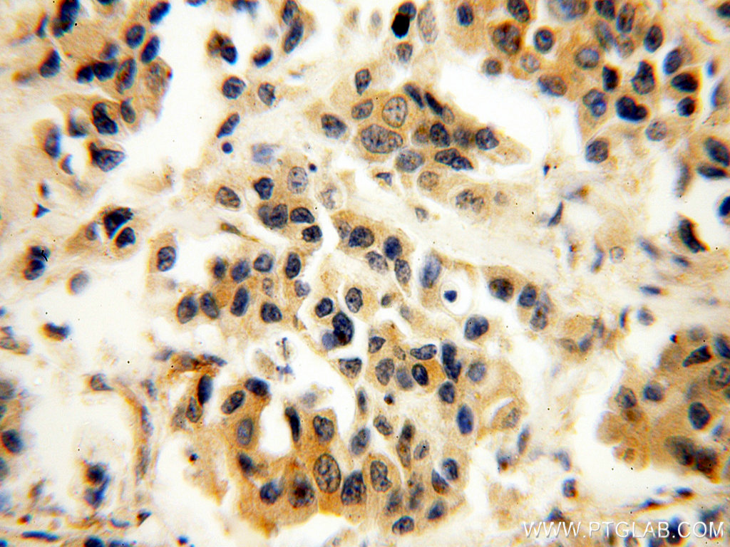 Immunohistochemical of paraffin-embedded human breast cancer using 18002-1-AP(P11 antibody) at dilution of 1:100 (under 40x lens)