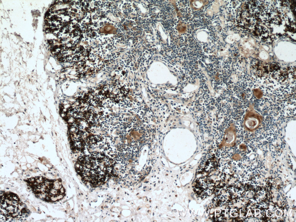Immunohistochemistry of paraffin-embedded human thymus tissue slide using 55143-1-AP( PSMB11 Antibody) at dilution of 1:200 (under 10x lens). heat mediated antigen retrieved with Tris-EDTA buffer(pH9).