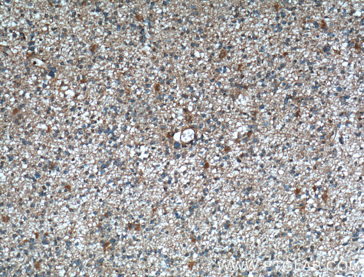 Immunohistochemistry of paraffin-embedded human gliomas tissue slide using 13355-1-AP( RAB39 Antibody) at dilution of 1:200 (under 10x lens). heat mediated antigen retrieved with Tris-EDTA buffer(pH9).