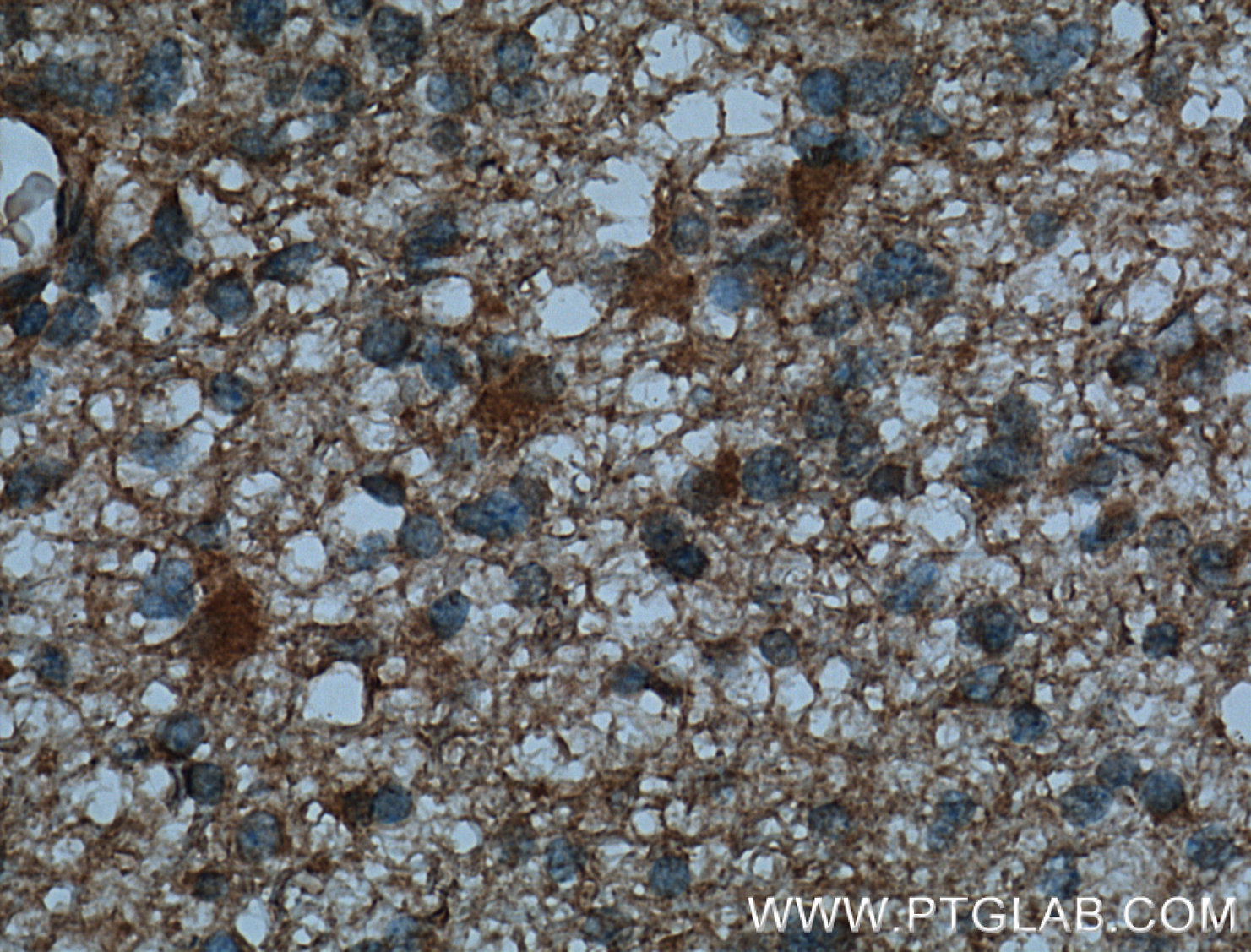 Immunohistochemistry of paraffin-embedded human gliomas tissue slide using 13355-1-AP( RAB39 Antibody) at dilution of 1:200 (under 40x lens). heat mediated antigen retrieved with Tris-EDTA buffer(pH9).