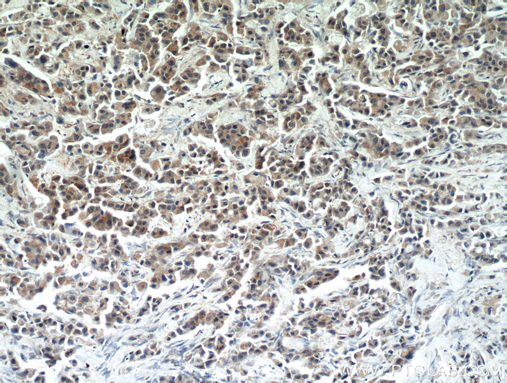 Immunohistochemical of paraffin-embedded human breast cancer using 10687-1-AP(RERG antibody) at dilution of 1:50 (under 10x lens)