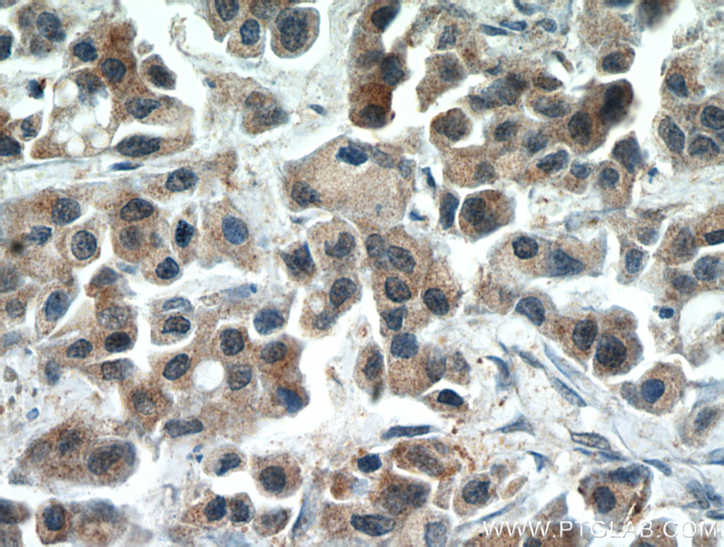 Immunohistochemical of paraffin-embedded human breast cancer using 10687-1-AP(RERG antibody) at dilution of 1:50 (under 40x lens)