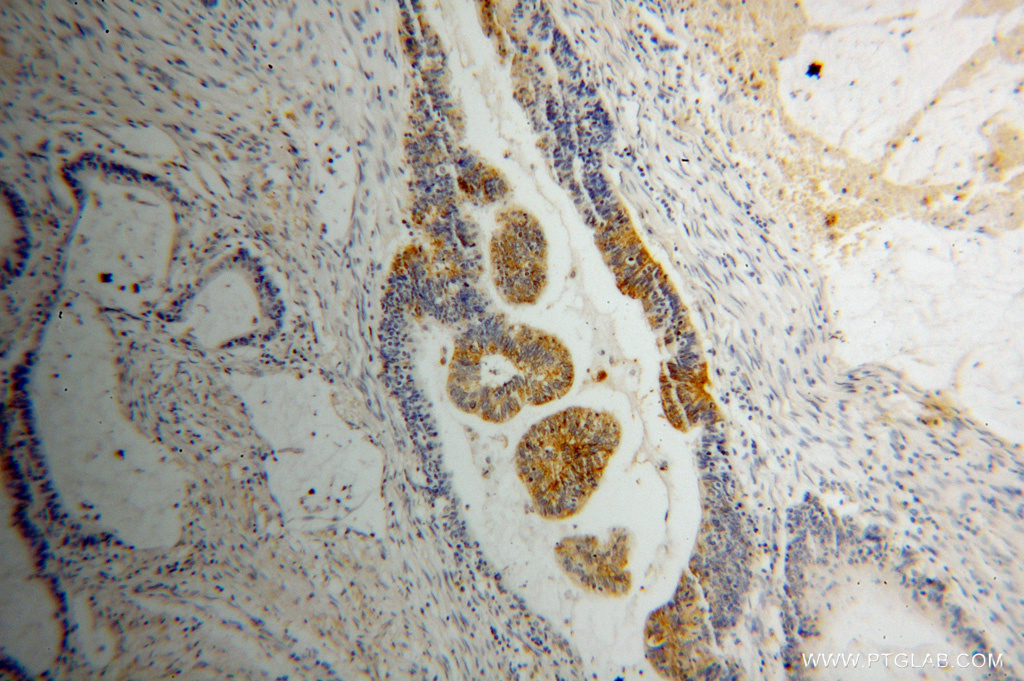 Immunohistochemical of paraffin-embedded human colon cancer using 15272-1-AP(RIBC2 antibody) at dilution of 1:50 (under 10x lens)