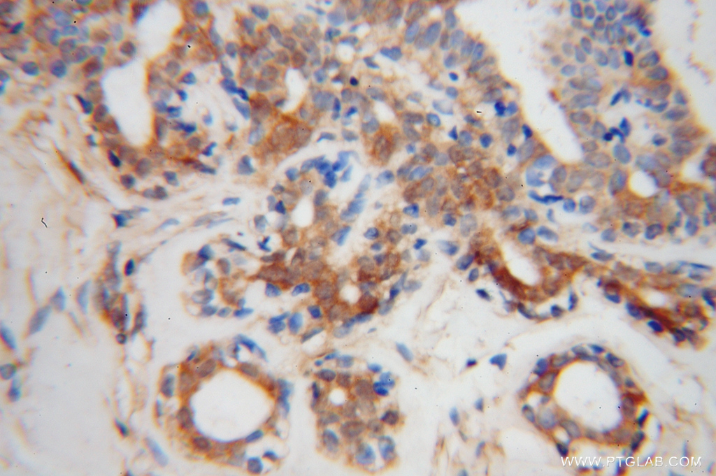 Immunohistochemical of paraffin-embedded human breast cancer using 15340-1-AP(RPL7A antibody) at dilution of 1:100 (under 40x lens)