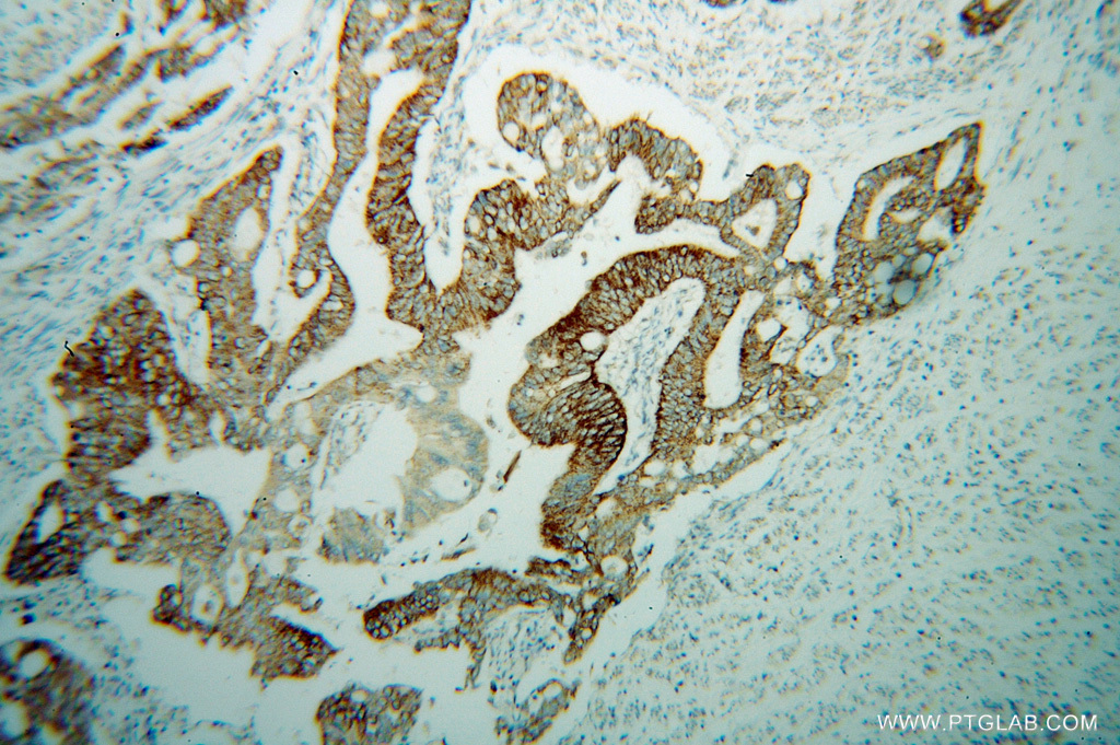 Immunohistochemical of paraffin-embedded human colon cancer using 14240-1-AP(SUCLG2 antibody) at dilution of 1:100 (under 10x lens)