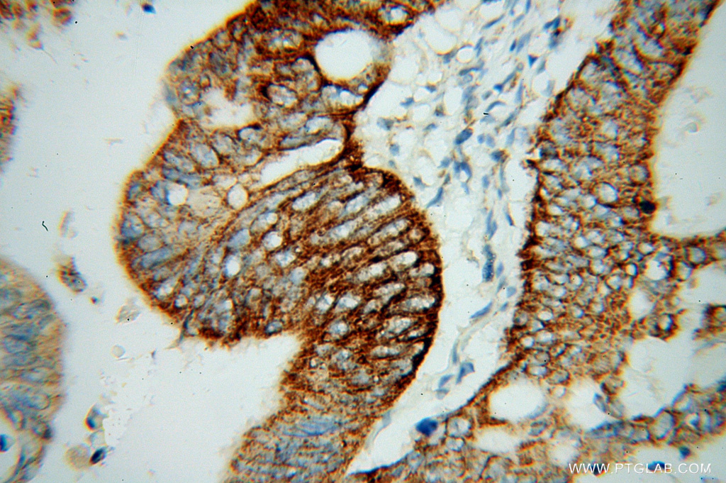 Immunohistochemical of paraffin-embedded human colon cancer using 14240-1-AP(SUCLG2 antibody) at dilution of 1:100 (under 40x lens)