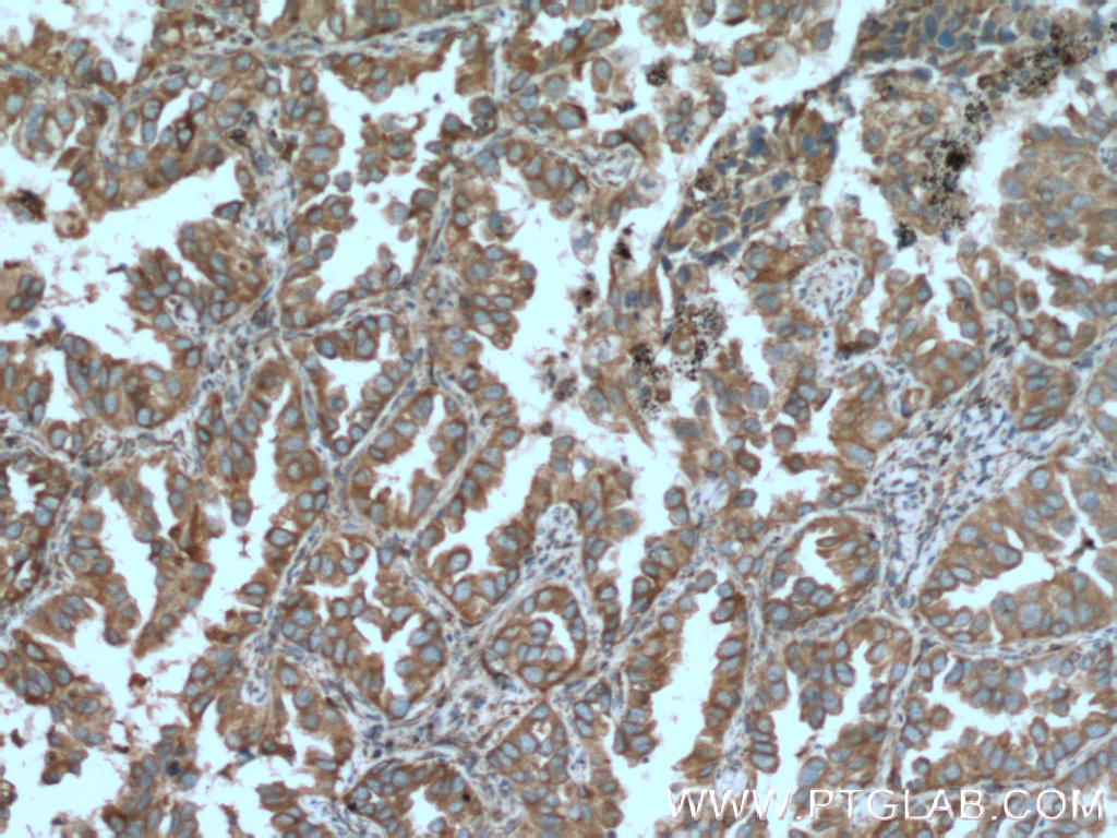 Immunohistochemistry of paraffin-embedded human lung cancer tissue slide using 55111-1-AP( TRPM1 Antibody) at dilution of 1:200 (under 10x lens). heat mediated antigen retrieved with Tris-EDTA buffer(pH9).