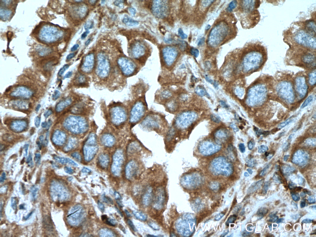 Immunohistochemistry of paraffin-embedded human lung cancer tissue slide using 55111-1-AP( TRPM1 Antibody) at dilution of 1:200 (under 40x lens). heat mediated antigen retrieved with Tris-EDTA buffer(pH9).