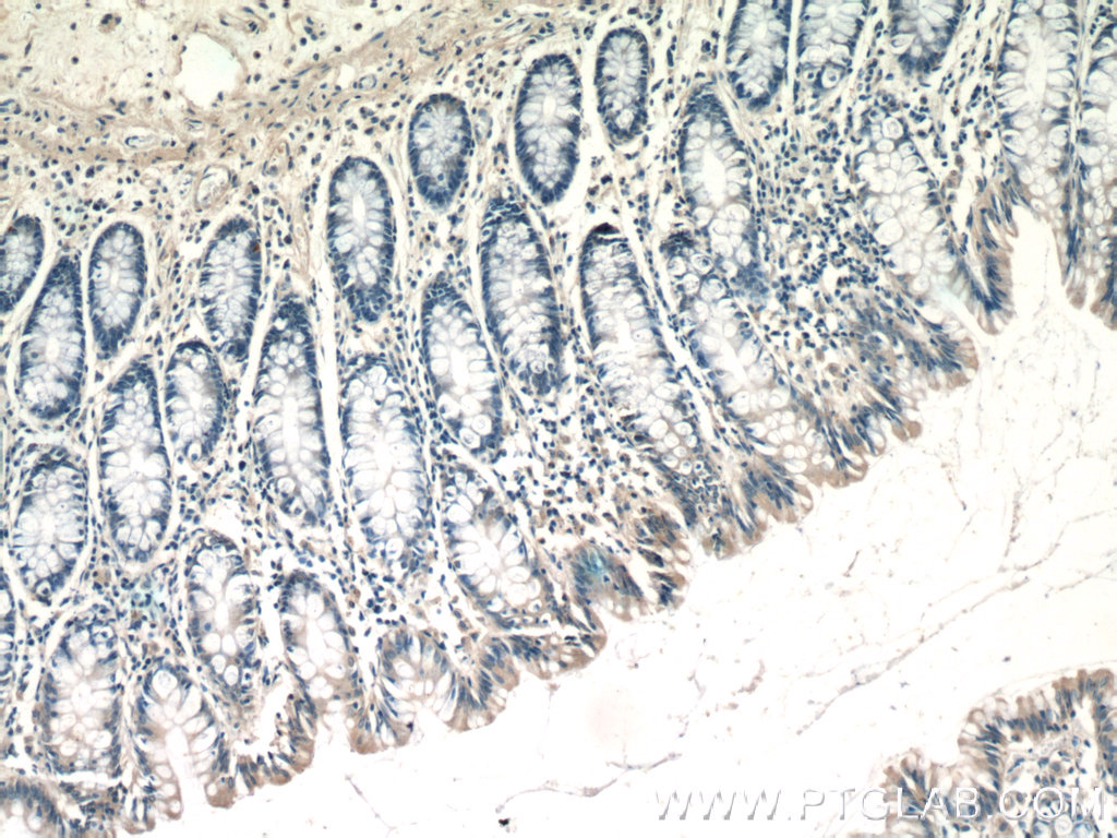 Immunohistochemistry of paraffin-embedded human colon tissue slide using 21600-1-AP( TTC7A Antibody) at dilution of 1:50 (under 10x lens)