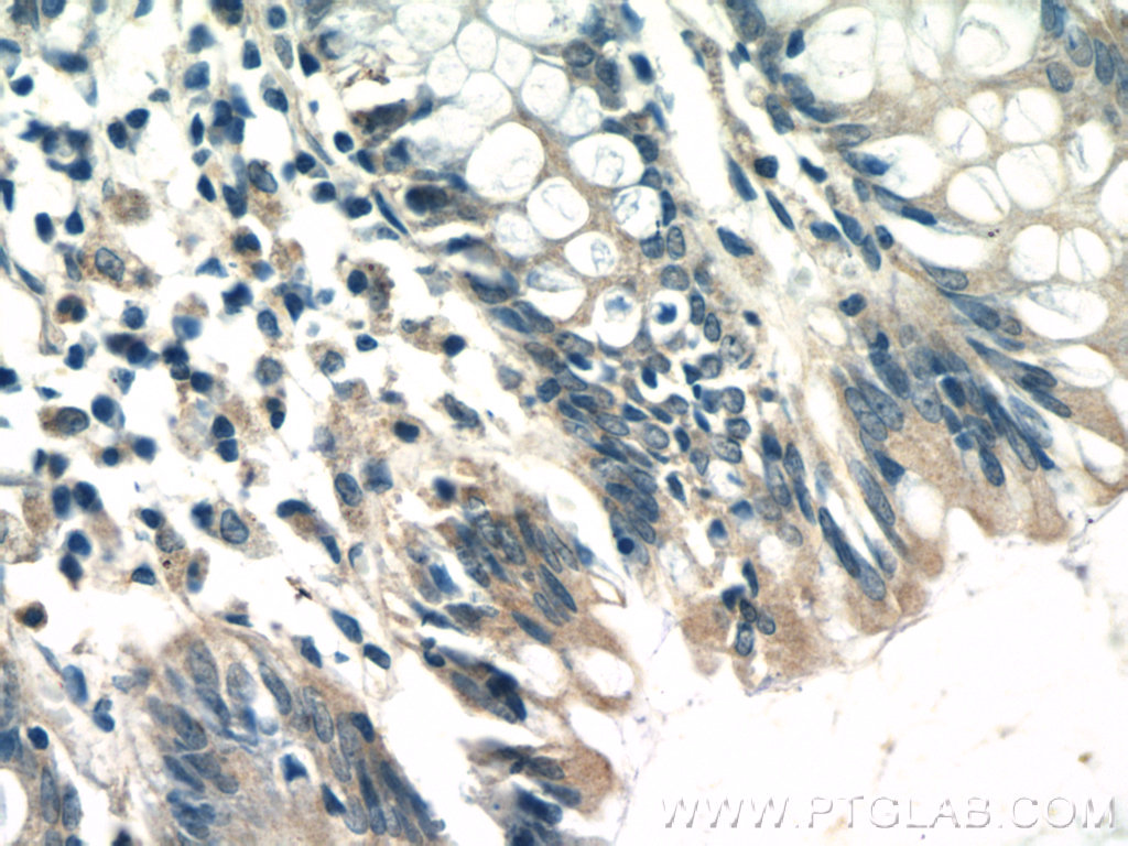 Immunohistochemistry of paraffin-embedded human colon tissue slide using 21600-1-AP( TTC7A Antibody) at dilution of 1:50 (under 40x lens)