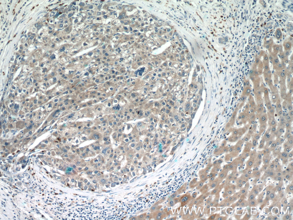 Immunohistochemistry of paraffin-embedded human liver cancer tissue slide using 25781-1-AP( C6orf125 Antibody) at dilution of 1:50 (under 10x lens)