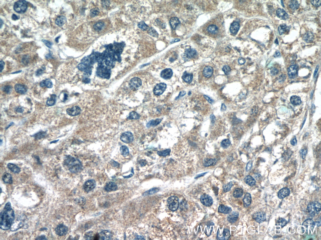 Immunohistochemistry of paraffin-embedded human liver cancer tissue slide using 25781-1-AP( C6orf125 Antibody) at dilution of 1:50 (under 40x lens)