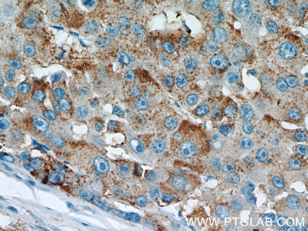Immunohistochemical of paraffin-embedded human liver cancer using 21039-1-AP(Willin antibody) at dilution of 1:50 (under 40x lens)