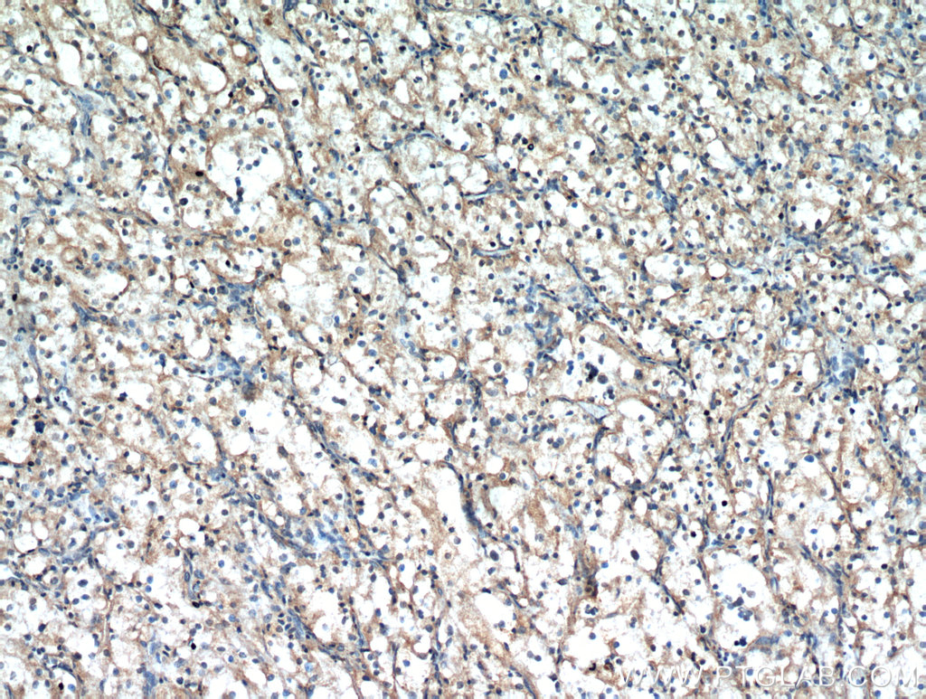 Immunohistochemical of paraffin-embedded human renal cell carcinoma using 20539-1-AP(ZNF839 antibody) at dilution of 1:50 (under 10x lens)