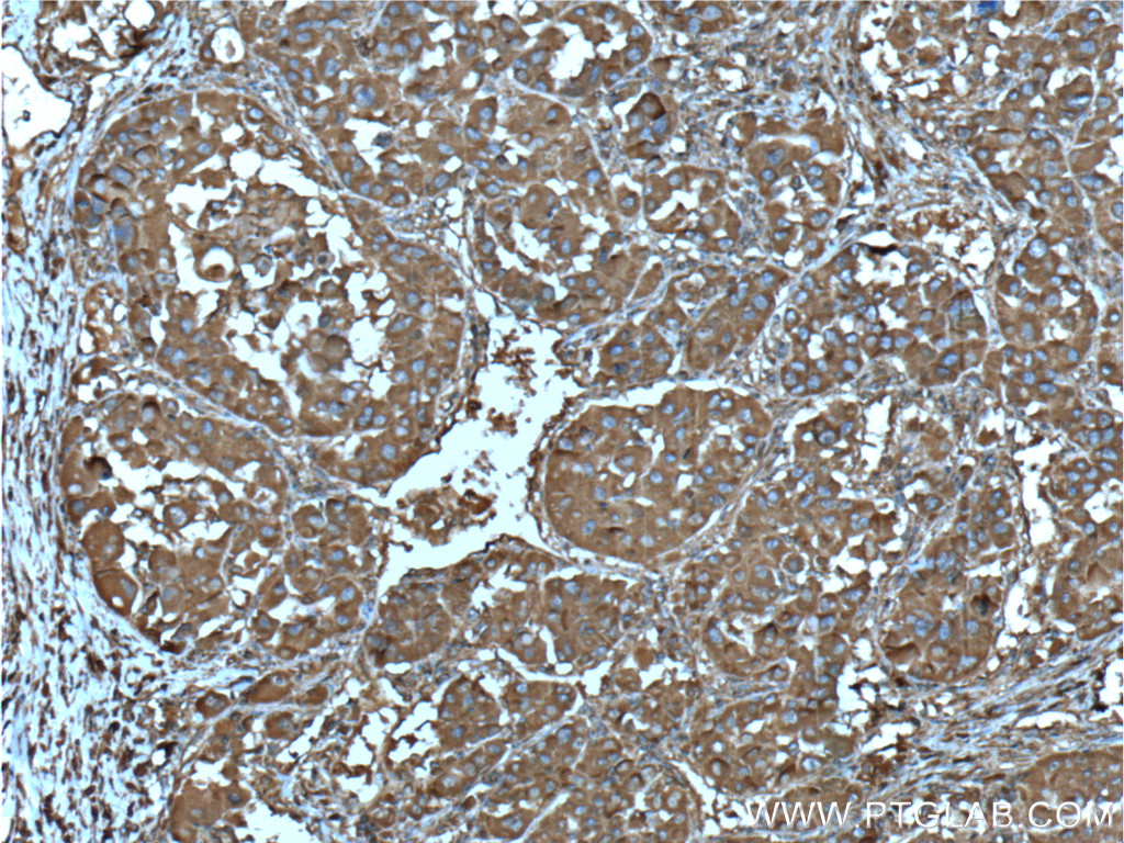 Immunohistochemistry of paraffin-embedded human liver cancer tissue slide using 60041-1-Ig( DSE Antibody) at dilution of 1:200 (under 10x lens). heat mediated antigen retrieved with Tris-EDTA buffer(pH9).