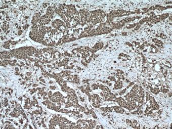 Immunohistochemistry of paraffin-embedded human colon cancer tissue slide using 26112-1-AP (TTC5 antibody) at dilution of 1:200 (under 10x lens) heat mediated antigen retrieved with Tris-EDTA buffer(pH9).