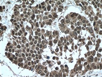 Immunohistochemistry of paraffin-embedded human colon cancer tissue slide using 26112-1-AP (TTC5 antibody) at dilution of 1:200 (under 40x lens) heat mediated antigen retrieved with Tris-EDTA buffer(pH9).