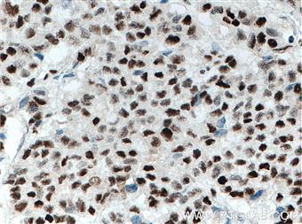 Immunohistochemistry of paraffin-embedded human colon cancer tissue slide using 66621-1-Ig (XRCC4 antibody) at dilution of 1:500 (under 40x lens) heat mediated antigen retrieved with Tris-EDTA buffer(pH9).
