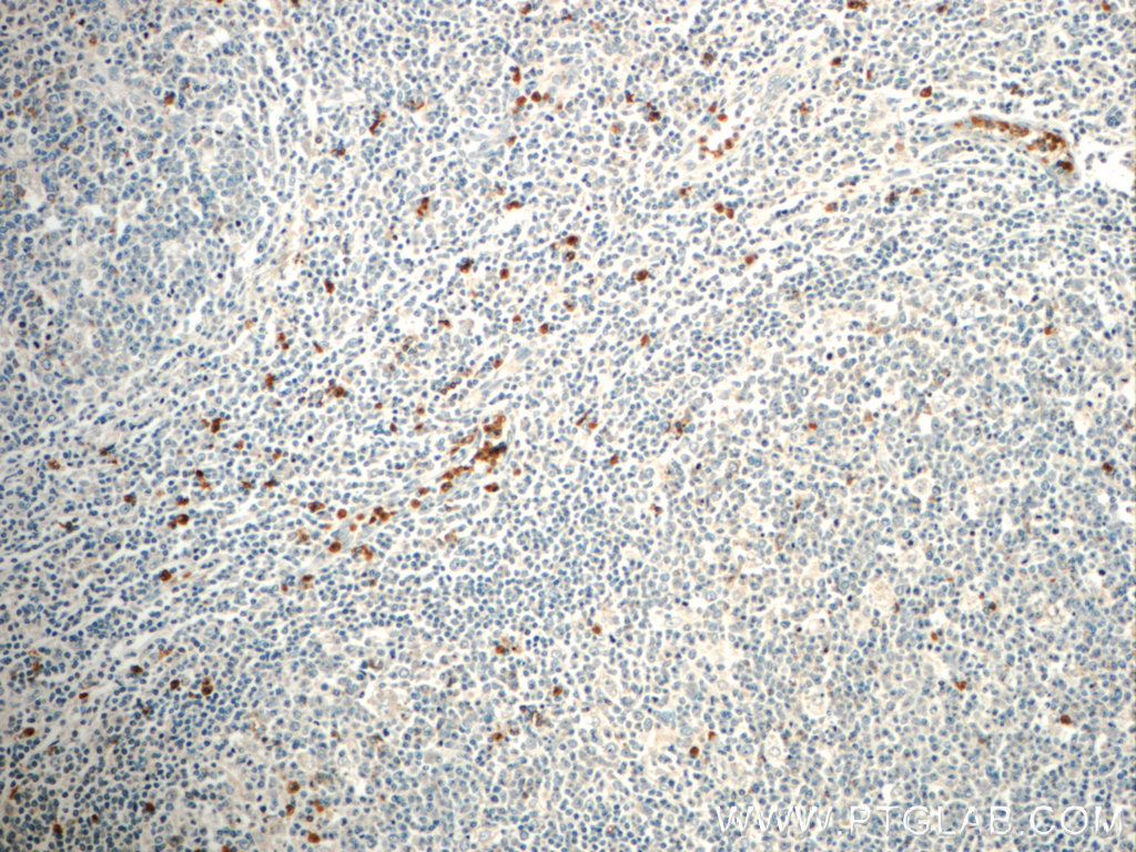 Immunohistochemistry of paraffin-embedded human tonsillitis slide using 21038-1-AP( FAM78A Antibody) at dilution of 1:50