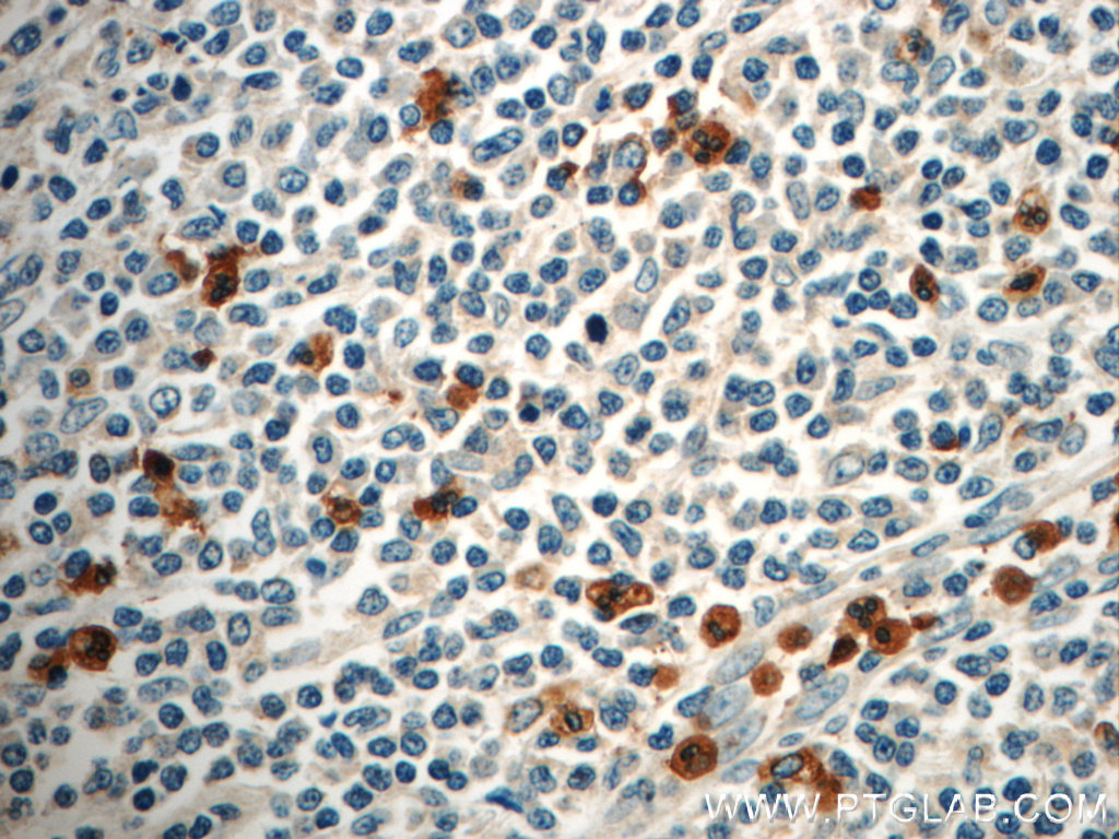 Immunohistochemistry of paraffin-embedded human tonsillitis slide using 21038-1-AP( FAM78A Antibody) at dilution of 1:50