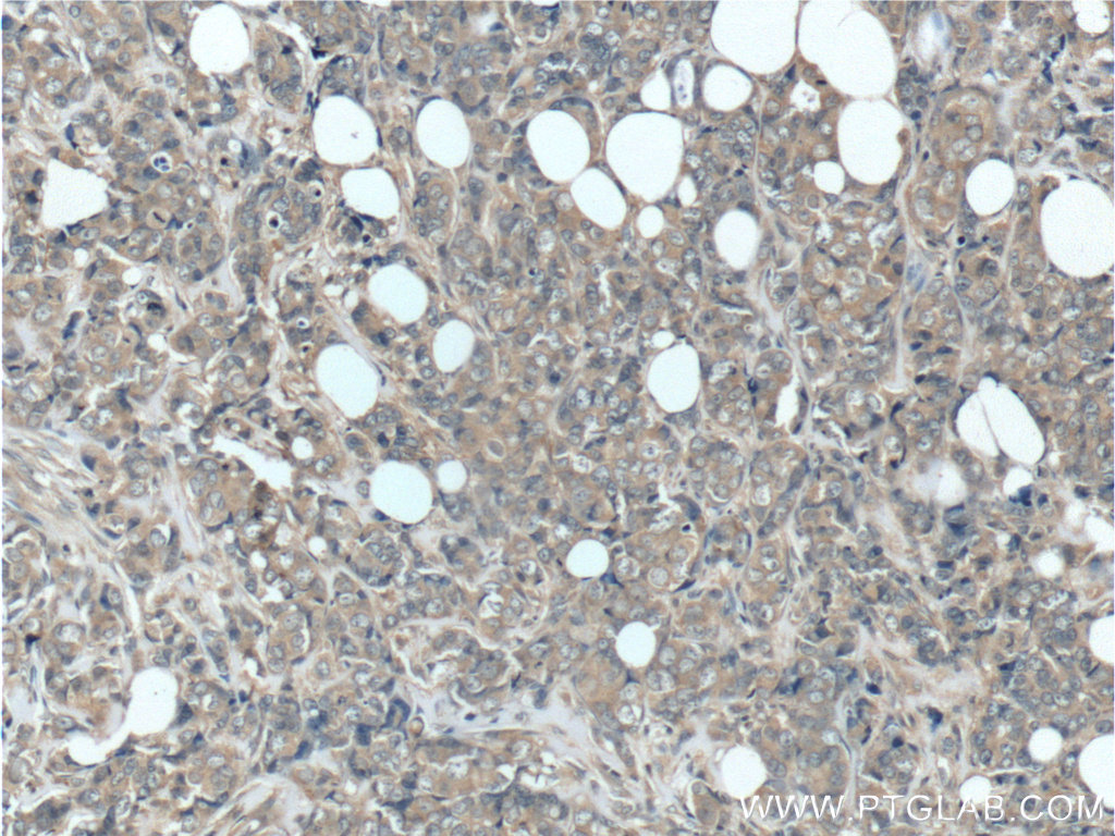Immunohistochemistry of paraffin-embedded human breast cancer tissue slide using 24790-1-AP( GIGYF2 Antibody) at dilution of 1:50 (under 10x lens)
