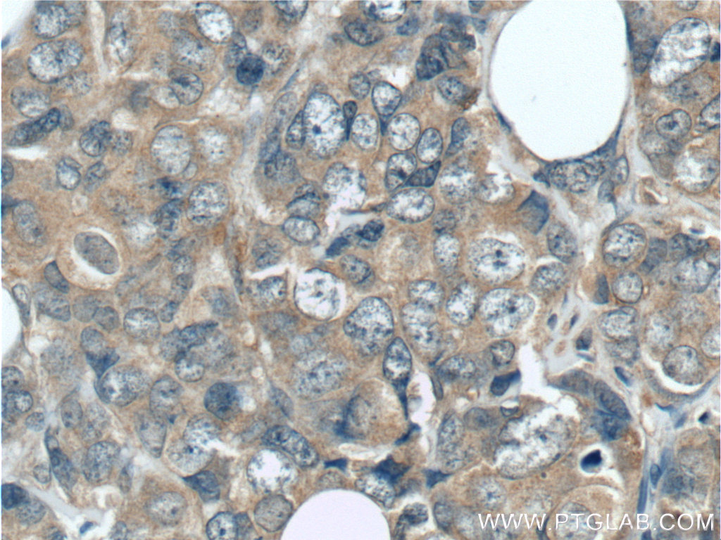 Immunohistochemistry of paraffin-embedded human breast cancer tissue slide using 24790-1-AP( GIGYF2 Antibody) at dilution of 1:50 (under 40x lens)