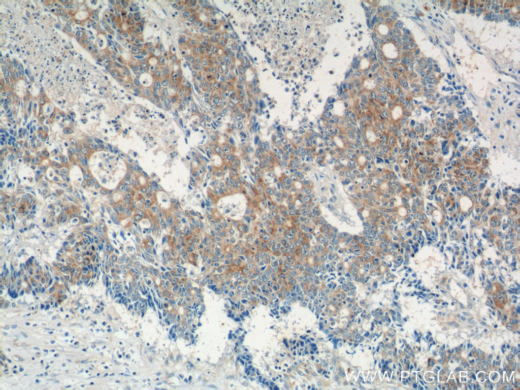 Immunohistochemistry of paraffin-embedded human colon cancer tissue slide using 25740-1-AP( IQCK Antibody) at dilution of 1:50 (under 10x lens)