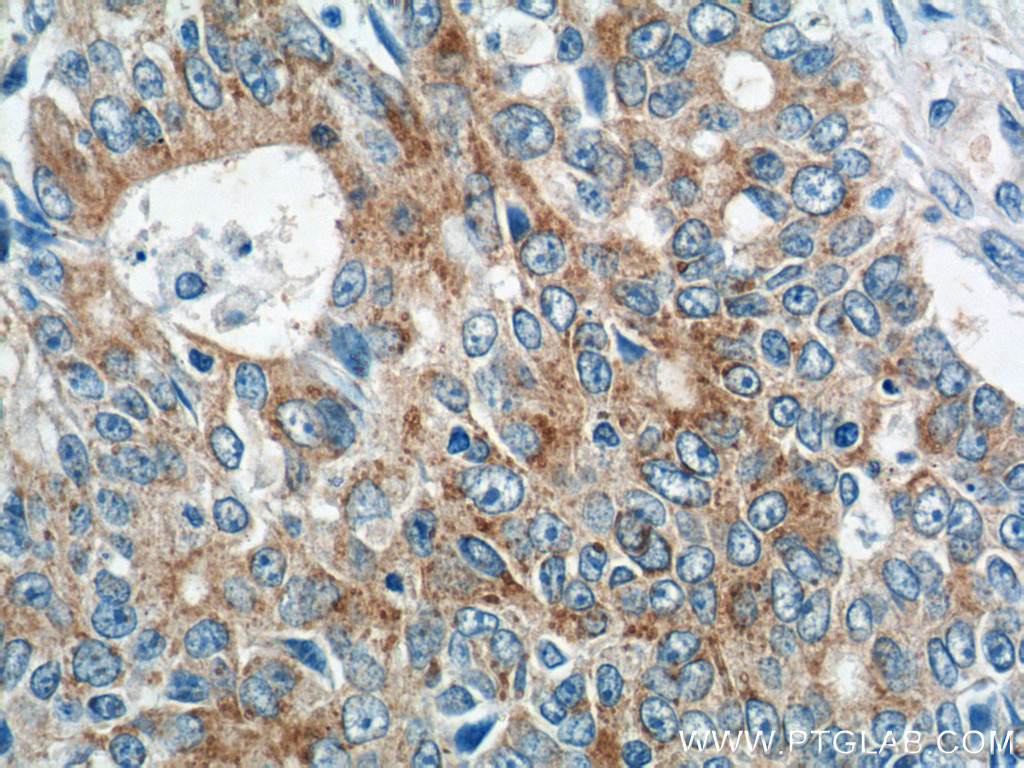 Immunohistochemistry of paraffin-embedded human colon cancer tissue slide using 25740-1-AP( IQCK Antibody) at dilution of 1:50 (under 40x lens)