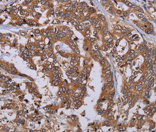 Immunohistochemistry of Human liver cancer using MFAP3L Polyclonal Antibody at dilution of 1:50