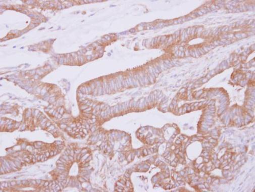 Immunohistochemical analysis of paraffin-embedded Colon ca, using THUMPD2 antibody at 1:500 dilution.