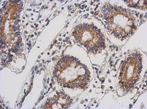 Immunohistochemical analysis of paraffin-embedded Gastric ca, using TTLL10 antibody at 1:500 dilution.